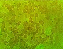 erytrocyty jak plaster miodu - marskosc watroby wywolana wirusem typu B.jpg